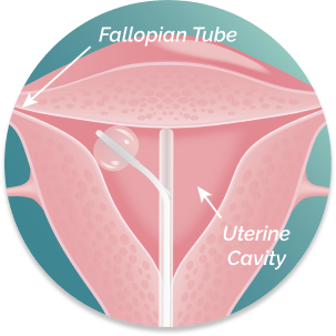 Illustration of uterus with FemaSeed inserted with balloon catheter extended into cornu of fallopian tube.
