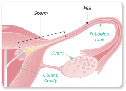 Illustration of uterus with sperm, egg, uterine cavity, ovary, and fallopian tube labeled.