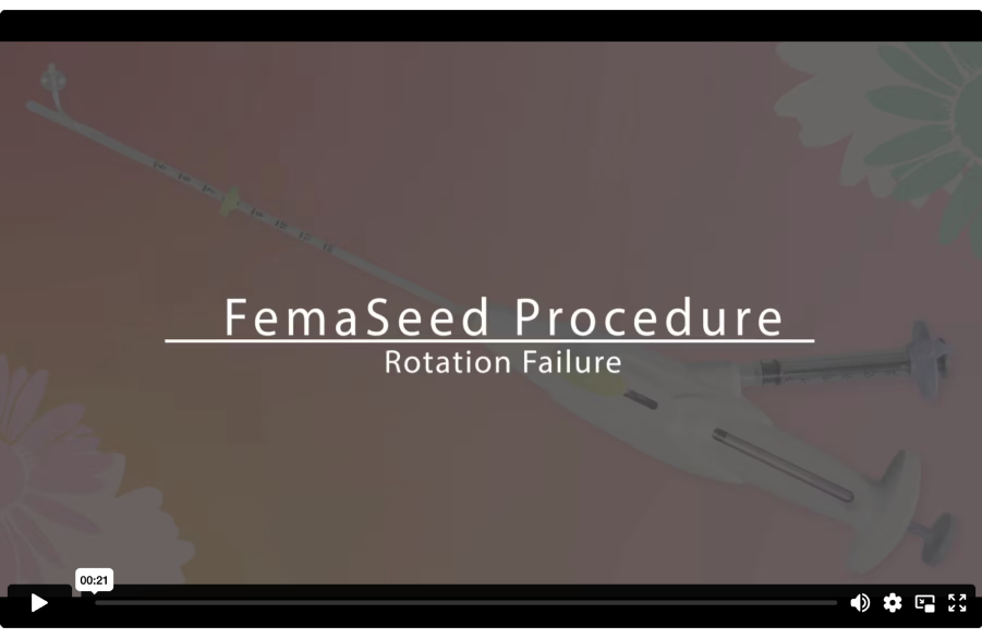 FemaSeed Procedure video showing a rotation failure