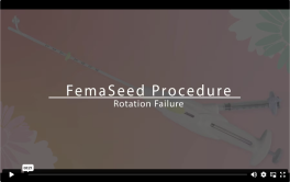 FemaSeed Procedure video showing a rotation failure