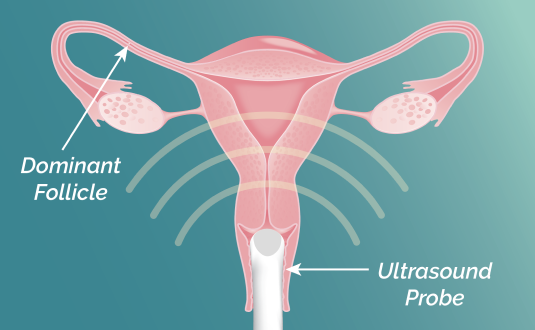 A vector illustration of cross section uterus with ultrasound probe inserted. The dominant follicle is labeled in the fallopian tube.