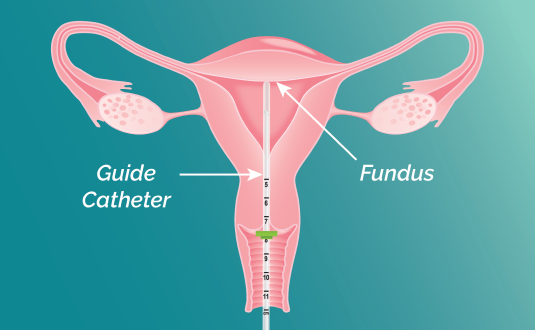 A vector illustration of cross section uterus with ultrasound probe inserted. The dominant follicle is labeled in the fallopian tube.