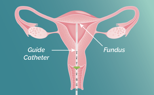 A vector illustration of cross section uterus with FemaSeed guide catheter visible, touching the uterine fundus.