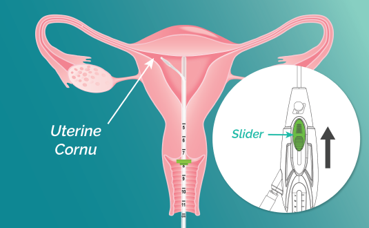 A vector illustration of cross section uterus with FemaSeed guide catheter visible, touching the uterine fundus.