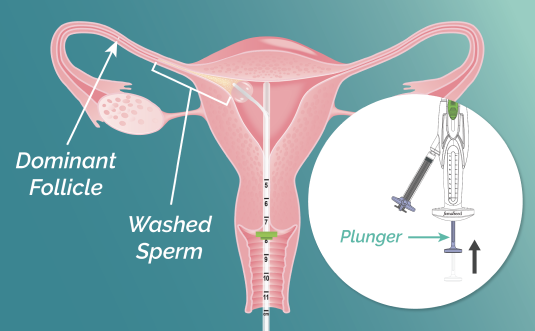 A vector illustration of cross section uterus with FemaSeed inserted, delivering washed sperm into the fallopian tube toward the dominant follicle. Inset image of device with plunger labeled.
