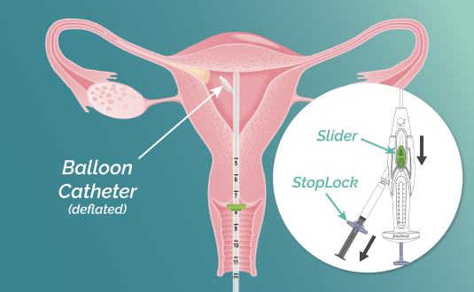 A vector illustration of cross section uterus with FemaSeed inserted, its balloon catheter deflated and in the process of being retracted. Inset image of device with slider and StopLock labeled.
