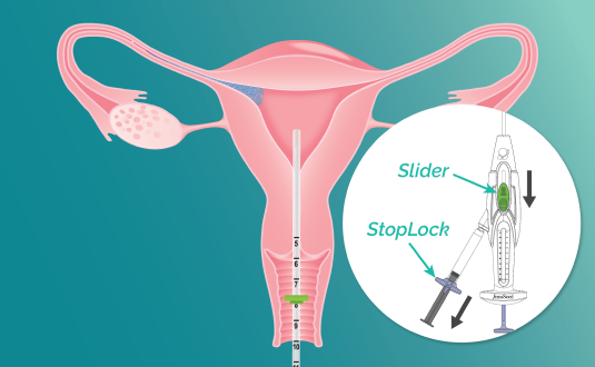 A vector illustration of cross section uterus with FemaSeed inserted, its balloon catheter deflated and in the process of being retracted. Inset image of device with slider and StopLock labeled.